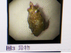 医院消化内科成功为一患者取出食管大型异物